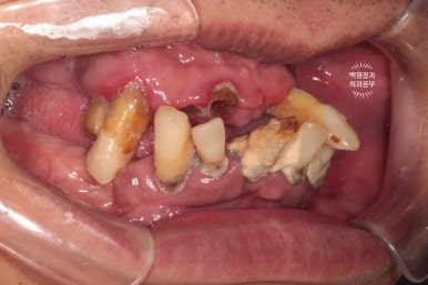 만성치주염으로 인해 아주 좁아진 잇몸뼈에 광범위한 뼈이식 + 전체임플란트. 신사 레브치과. 관련 이미지 5