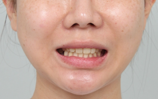 신사역 라미네이트. 결혼식 전 앞니 고민, 얇은 세라믹 레브네이트로 해결! 관련 이미지 21