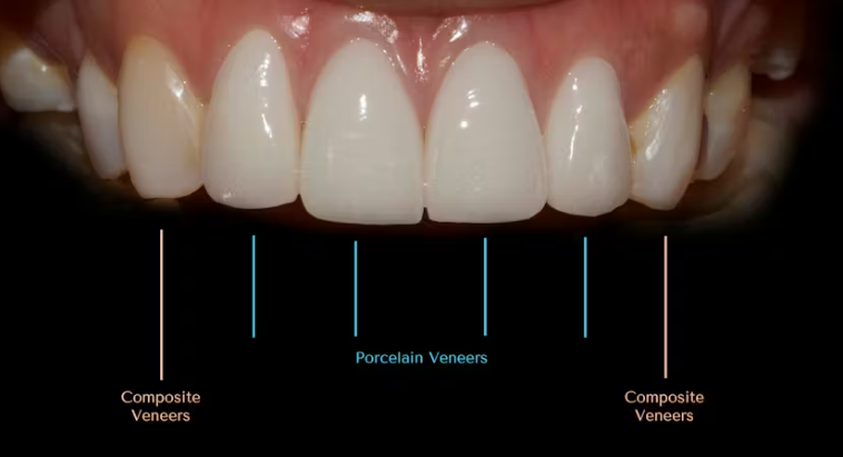 왜소치 라미네이트. 열심히 교정치료 받은 나를 위한 선물. 비용/과정/후기. 관련 이미지 12