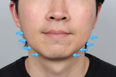 서울 신사역 [레브치과] 이갈이 보톡스 - 치과에서 코어톡스로 - 3개월 후기/주기/용량/가격. (의사작성) 관련 이미지 8