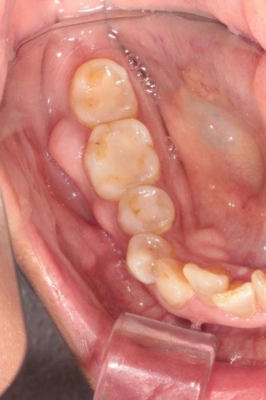 삐뚤어진 앞니를 8개월만에 가지런하게 만드는 50대 성인부분교정. 신사역 교정치과. 치료과정/기간/비용. 관련 이미지 6