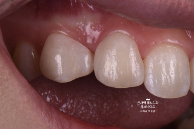 신사역 치과. 아나운서 면접 전 앞니 벌어진 공간을 라미네이트로만 해결할 수 있었던 사연.. 관련 이미지 21