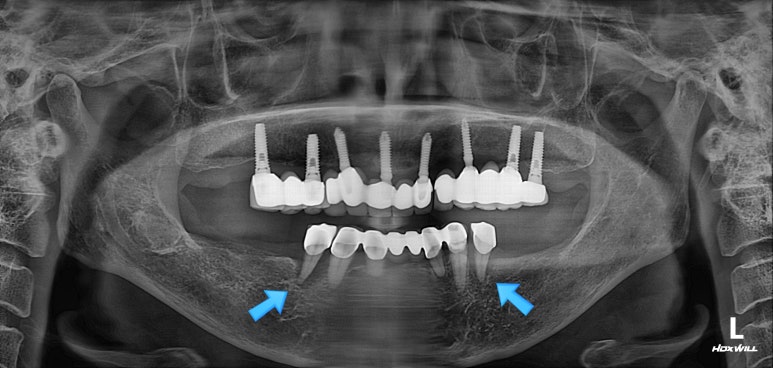 부분틀니를 오래써서 어금니가 아플 때, 아래턱 양쪽 어금니 임플란트 잘하는 강남임플란트치과 관련 이미지 6