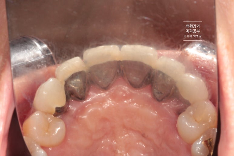 크라운 앞니 충치로 냄새가 나요 - 최소한의 임플란트와 씌우는 치료. 치료과정/기간/비용. 관련 이미지 5