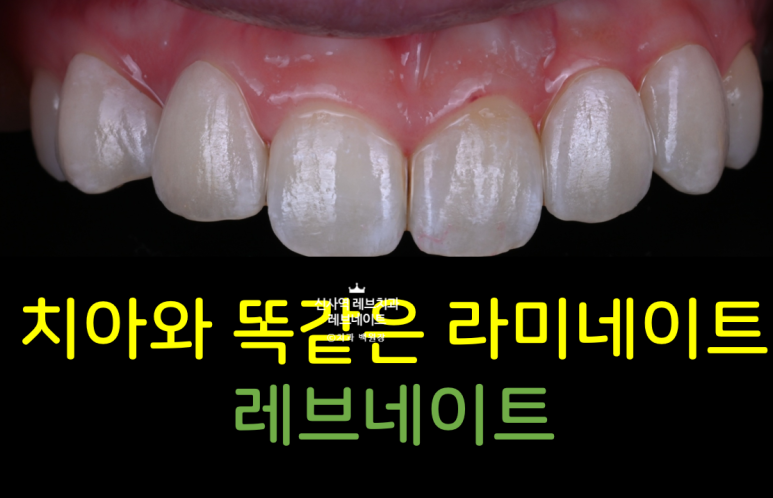 신사역 치과. 아나운서 면접 전 앞니 벌어진 공간을 라미네이트로만 해결할 수 있었던 사연.. 관련 이미지 1