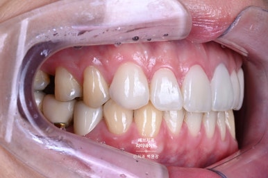 레브네이트 엑스퍼트 ; 유튜버가 선택한 앞니 라미네이트. 앞니 레진 벌어짐을 자연스러우면서 화사하게 바꿔봅시다. 신사역 치과. 치료후기/비용/가격. 관련 이미지 12