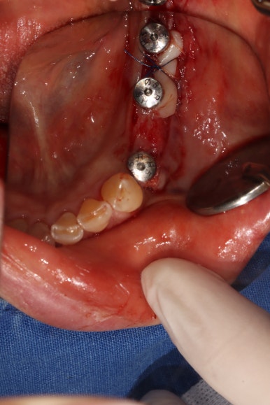 어금니 임플란트 주변 잇몸이식수술 - 저는 해야한다고 생각합니다. (feat. 대한치과의사협회 논문 + 치주과전문) 관련 이미지 20