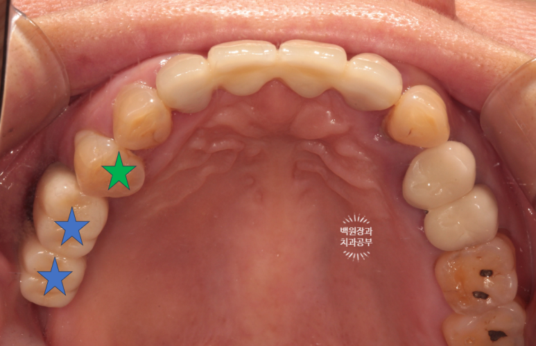 60대 임플란트 주변에서 고름이 나와요. 실패한 임플란트 제거 후 재수술. 덴티움 뼈이식재를 사용한 치조골 이식술. 관련 이미지 4
