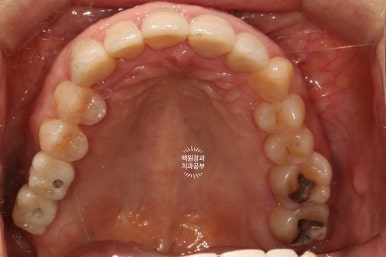 삐뚤빼뚤 앞니 세로 금  - 신경치료 없이 지르코니아 크라운으로. 상악동뼈이식술 임플란트. 관련 이미지 23