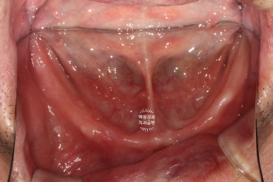 아래 어금니 임플란트 6개면 틀니를 안써도 됩니다.  치주염 전문 착한치과. 치료기간/임시치아과정/후기/비용. 관련 이미지 36