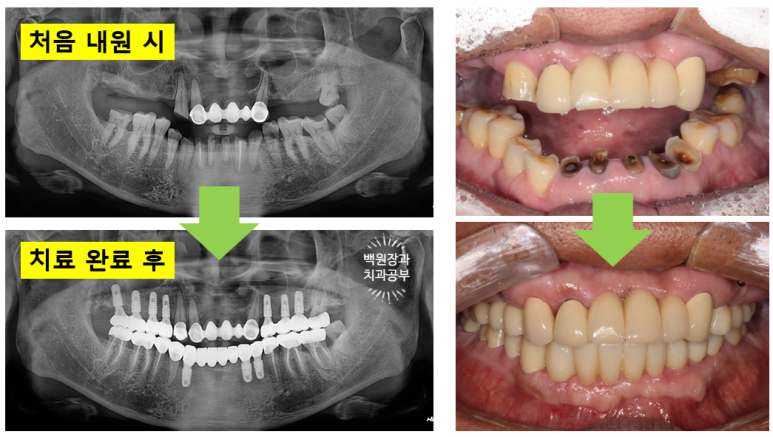 뿌리만 남은 앞니, 어금니가 없어 교합이 무너진 증례. 흡연자의 전체 오스템BA임플란트 재건증례. 치료과정/치료기간/비용/후기. 관련 이미지 32