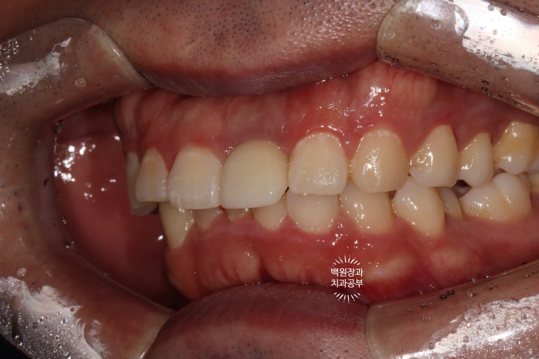 앞니 머리가 기둥째 부러졌어요. 발치 동시 뼈이식 오스템 BA 임플란트. 치료과정/치료기간/비용/후기. 압구정 치과. 관련 이미지 24