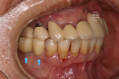 스트라우만 임플란트로 이뽑고 바로심는치과 - 믿고 사용하는 세계 1위 스위스 임플란트 회사. 관련 이미지 29