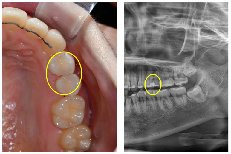 옆면 어금니 충치 하루만에 가능한 논현동 치과. 치아미백 가격 후기. 관련 이미지 9