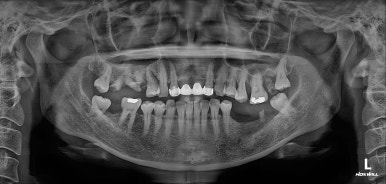 전세계 1위 스트라우만 임플란트를 사용한 어금니 기능회복과 앞니 지르코니아 크라운 증례. 관련 이미지 30
