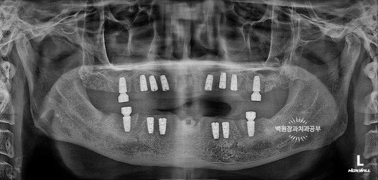 오스템임플란트 네비게이션 전체 임플란트 치료일기. 치료과정/치료기간/비용/솔직후기. 관련 이미지 7