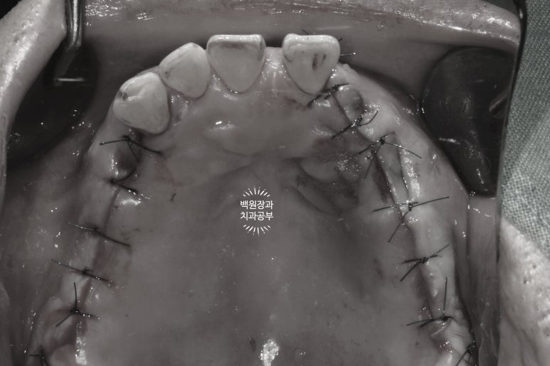 임플란트장인의 마음으로 8개월간 전체임플란트 완성. 치주과 전문의. 관련 이미지 14