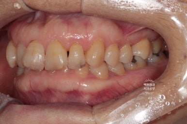 삐뚤빼뚤 앞니 세로 금  - 신경치료 없이 지르코니아 크라운으로. 상악동뼈이식술 임플란트. 관련 이미지 4