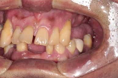 큰 어금니를 잃을 정도의 풍치를 앓으셨다면, 조속한 어금니 임플란트는 필수입니다. 관련 이미지 4