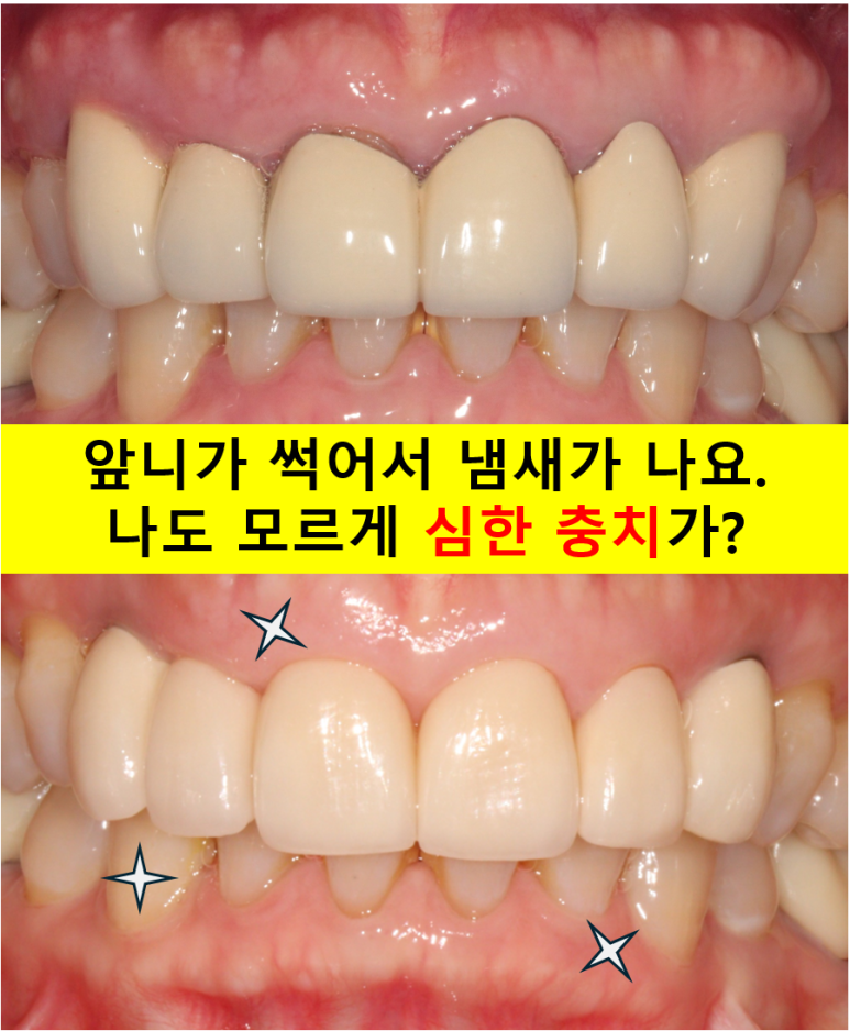 크라운 앞니 충치로 냄새가 나요 - 최소한의 임플란트와 씌우는 치료. 치료과정/기간/비용. 관련 이미지 1