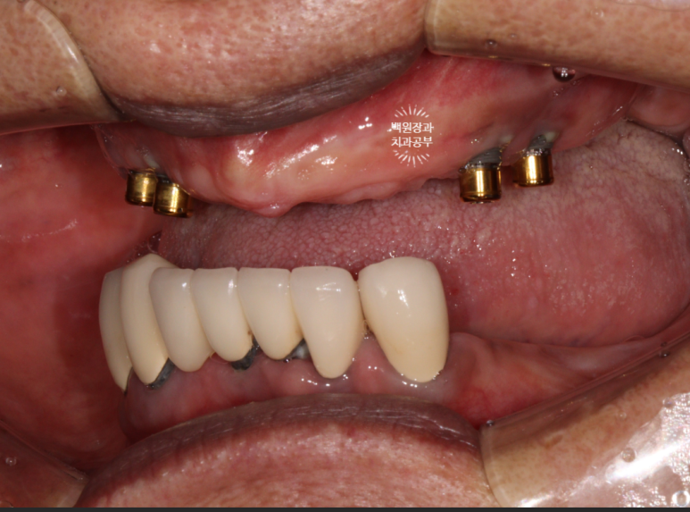 임플란트에서 고름이 나와요. 임플란트 주위염 그리고 재수술을 위한 준비. 치료과정/치료기간/비용/후기. 관련 이미지 6