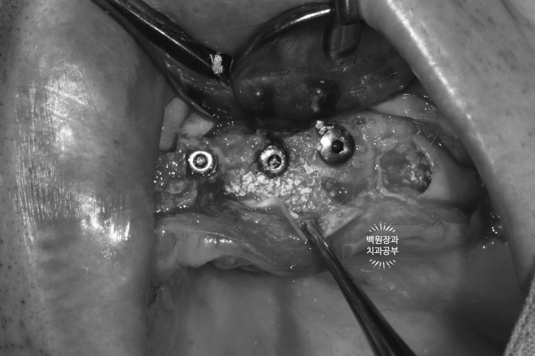 만성치주염으로 인해 아주 좁아진 잇몸뼈에 광범위한 뼈이식 + 전체임플란트. 신사 레브치과. 관련 이미지 26