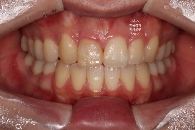 잇몸 성형과 치아미백 그리고 지르코니아 20대 앞니 크라운 치료. 치료과정/기간/비용. 관련 이미지 16