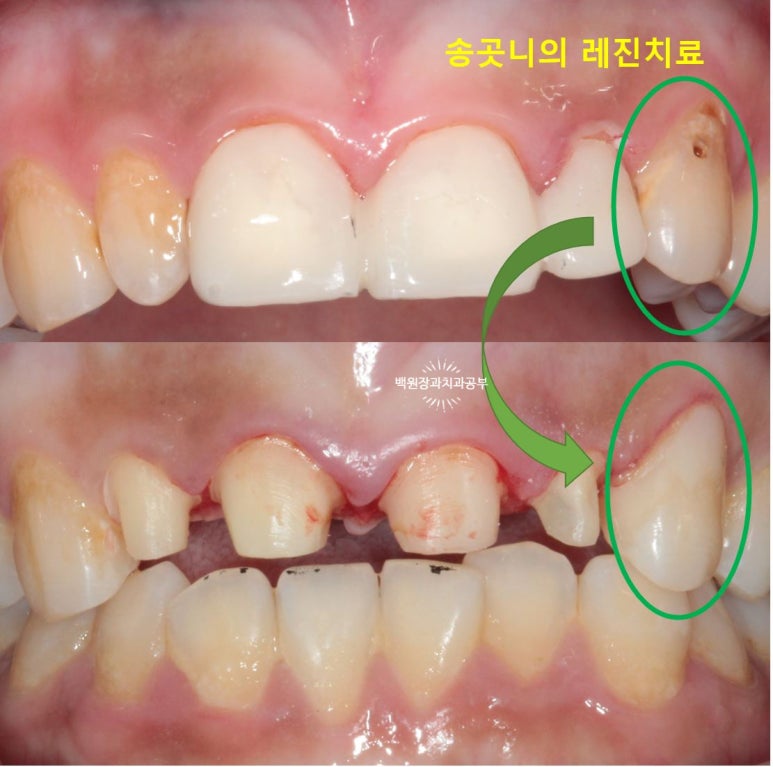 앞니에 잇몸염증과 충치가 심해요. 앞니 지르코니아 크라운 성공 후기. 치료과정/치료기간/비용/전후비교. 관련 이미지 16