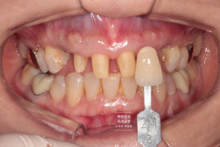 크라운 앞니 충치로 냄새가 나요 - 최소한의 임플란트와 씌우는 치료. 치료과정/기간/비용. 관련 이미지 11