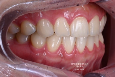 신사역 라미네이트, 잘하는 치과의 치료과정과 재료.설명.비용.후기. 관련 이미지 2
