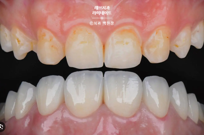 레브네이트 마스터 ; 예비신랑 앞니 무삭제라미네이트. 신사역 치과. 치료후기/비용/가격. 관련 이미지 5