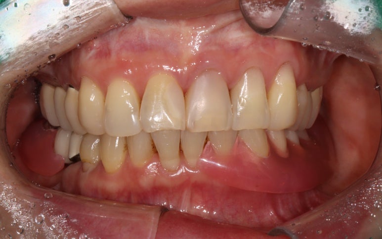 어금니 임플란트 주변 잇몸이식수술 - 저는 해야한다고 생각합니다. (feat. 대한치과의사협회 논문 + 치주과전문) 관련 이미지 11