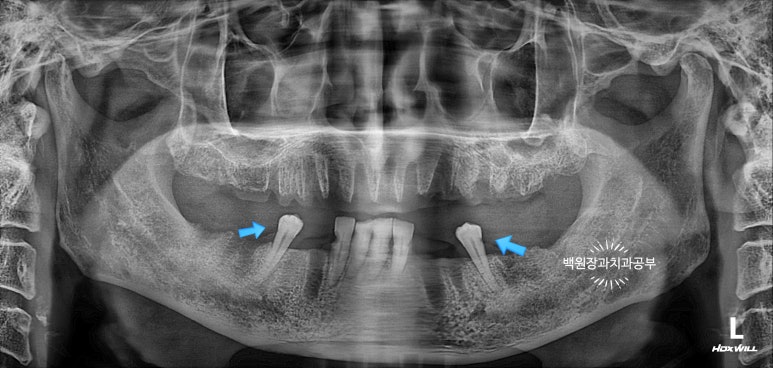 오스템임플란트 네비게이션 전체 임플란트 치료일기. 치료과정/치료기간/비용/솔직후기. 관련 이미지 3