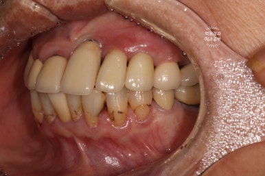 스트라우만 임플란트로 이뽑고 바로심는치과 - 믿고 사용하는 세계 1위 스위스 임플란트 회사. 관련 이미지 28