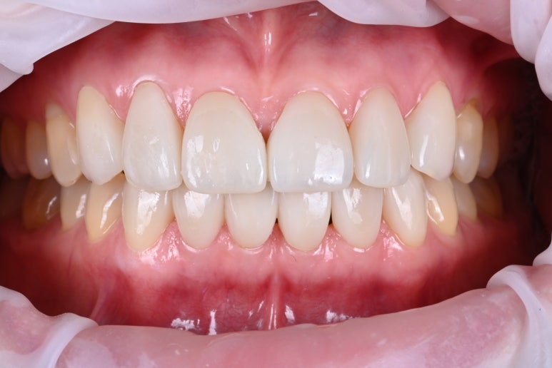 레브네이트 엑스퍼트 - 앞니 무삭제 라미네이트. 40대 벌어진 앞니에 변색된 레진은 이제 그만! 압구정 치과 추천 전후/비용. 관련 이미지 13