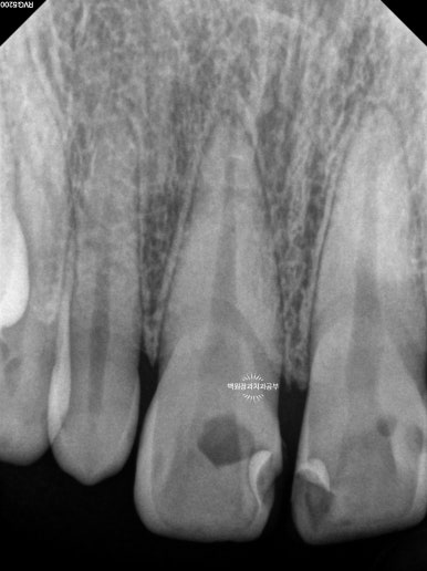 앞니에 잇몸염증과 충치가 심해요. 앞니 지르코니아 크라운 성공 후기. 치료과정/치료기간/비용/전후비교. 관련 이미지 6