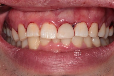 앞니 머리가 기둥째 부러졌어요. 발치 동시 뼈이식 오스템 BA 임플란트. 치료과정/치료기간/비용/후기. 압구정 치과. 관련 이미지 16