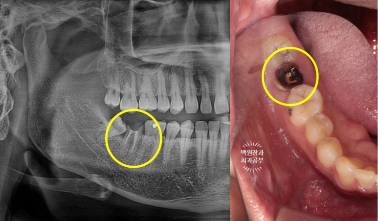아래 어금니가 없어 위 어금니가 내려왔어요. 부분 교정을 곁들인 스트라우만 임플란트 수술. 억울한 신경치료를 피해보자. 치료과정/치료기간/비용/후기. 관련 이미지 3