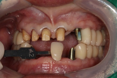 임플란트장인의 마음으로 8개월간 전체임플란트 완성. 치주과 전문의. 관련 이미지 26