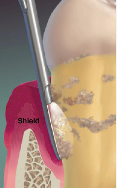 잇몸치료에 대한 모든 것. 치주과 전문의가 설명하는 치주염 치료 비용,과정, 통증, 방법 그리고 치과 실비보험. 관련 이미지 11
