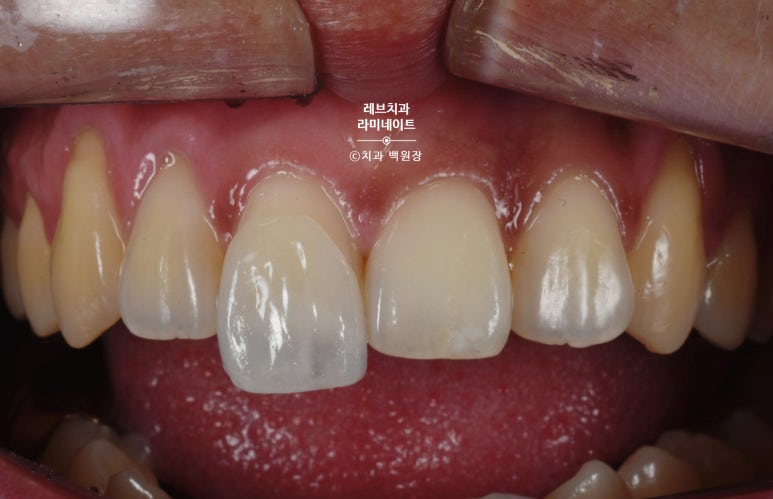 레브네이트 마스터 ; 예비신랑 앞니 무삭제라미네이트. 신사역 치과. 치료후기/비용/가격. 관련 이미지 11