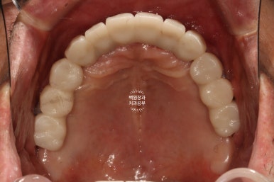 불편한 틀니를 아직도 쓰시나요? 전체 임플란트 치료비용/치료기간/치료과정. 관련 이미지 27