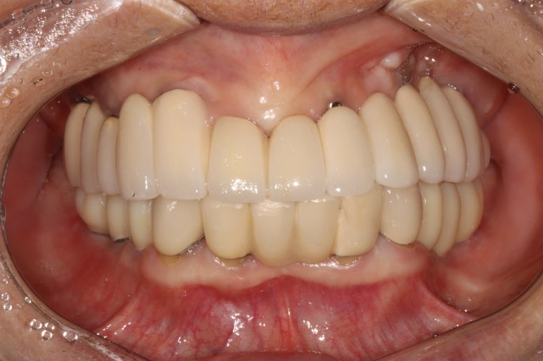 부분틀니를 오래써서 어금니가 아플 때, 아래턱 양쪽 어금니 임플란트 잘하는 강남임플란트치과 관련 이미지 22