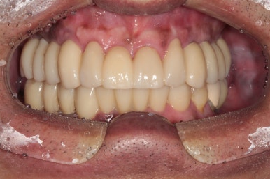 큰 어금니를 잃을 정도의 풍치를 앓으셨다면, 조속한 어금니 임플란트는 필수입니다. 관련 이미지 15