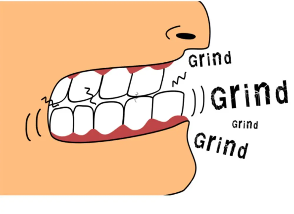 신사역 치과 - 이갈이와 이악물기의 치료. 좋은 보톡스와 이갈이 스플린트. 코어톡스 가격/주기/효과. 관련 이미지 5