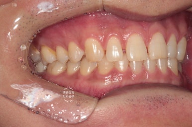 아래 어금니가 없어 위 어금니가 내려왔어요. 부분 교정을 곁들인 스트라우만 임플란트 수술. 억울한 신경치료를 피해보자. 치료과정/치료기간/비용/후기. 관련 이미지 13