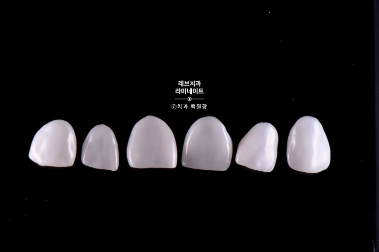 신사역 무삭제 라미네이트 : 레브네이트 내츄럴 최소삭제 비니어. 50대 앞니 벌어짐 비용/후기/얼굴사진. 관련 이미지 9