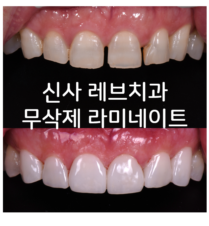 신사역 무삭제 라미네이트 : 레브네이트 내츄럴 최소삭제 비니어. 50대 앞니 벌어짐 비용/후기/얼굴사진. 관련 이미지 1