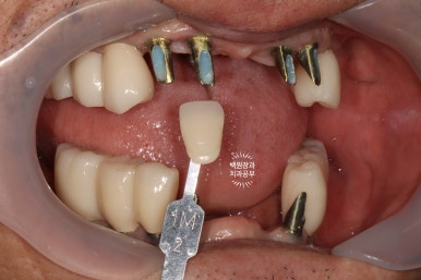 불편한 틀니를 아직도 쓰시나요? 전체 임플란트 치료비용/치료기간/치료과정. 관련 이미지 23