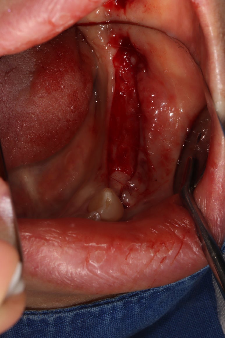 어금니 임플란트 주변 잇몸이식수술 - 저는 해야한다고 생각합니다. (feat. 대한치과의사협회 논문 + 치주과전문) 관련 이미지 18